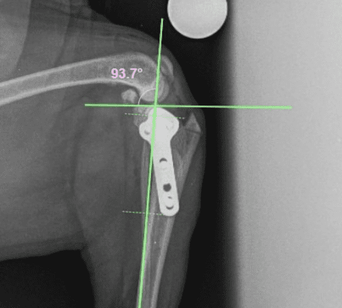 RUPTURA DE LIGAMENTO CRUZADO Y CIRUGÍA DE NIVELACIÓN DE PLATO TIBIAL